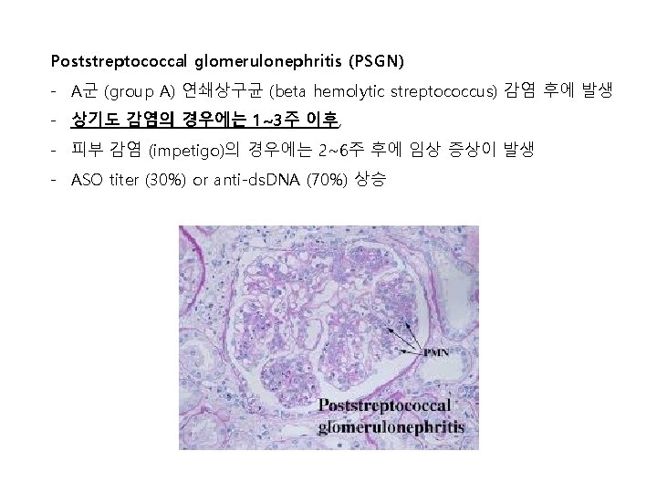 Poststreptococcal glomerulonephritis (PSGN) - A군 (group A) 연쇄상구균 (beta hemolytic streptococcus) 감염 후에 발생