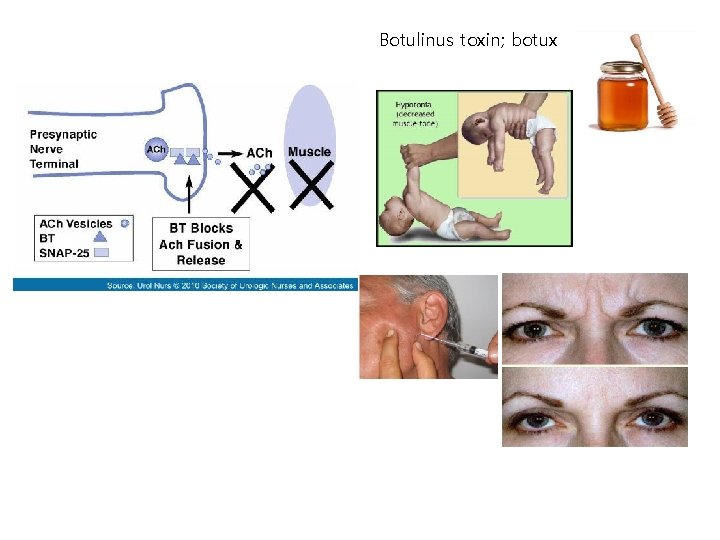 Botulinus toxin; botux 