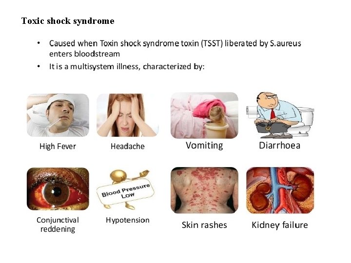 Toxic shock syndrome 