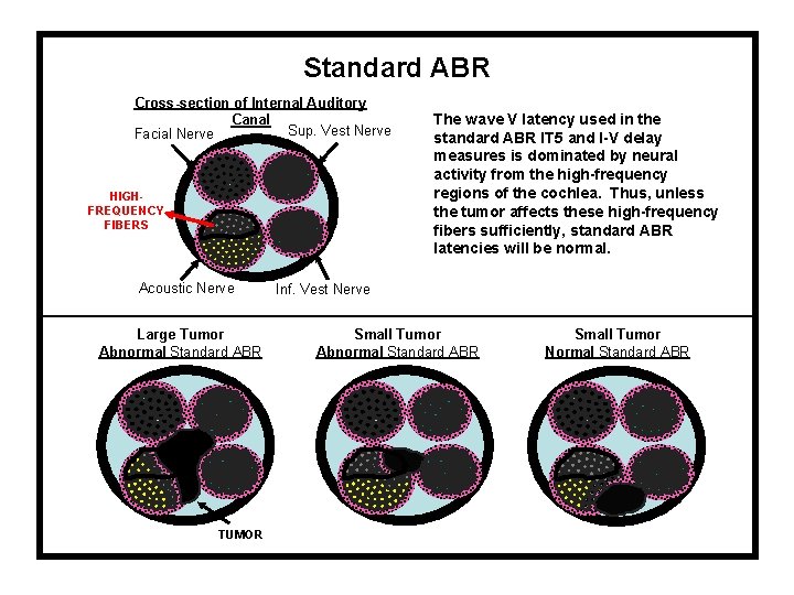 Standard ABR Cross-section of Internal Auditory Canal Sup. Vest Nerve Facial Nerve HIGHFREQUENCY FIBERS