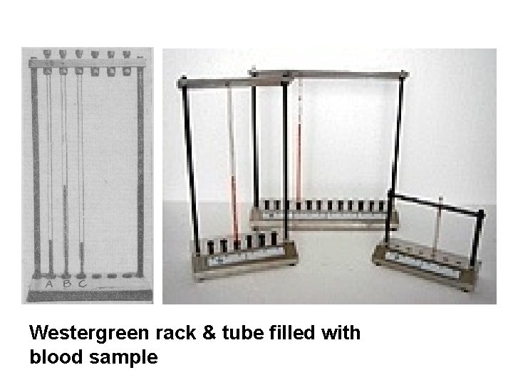 Westergreen rack & tube filled with blood sample 