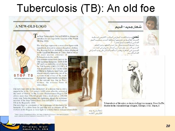 Tuberculosis (TB): An old foe 20 Tuberculosis (TB): An old foe 20