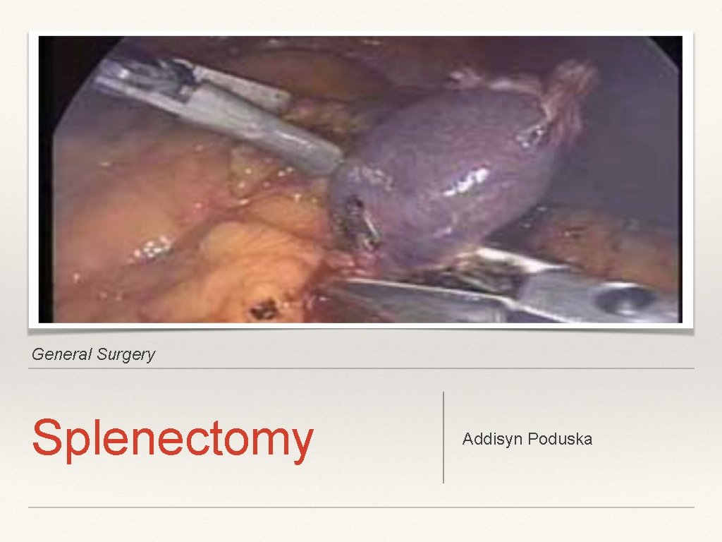General Surgery Splenectomy Addisyn Poduska 