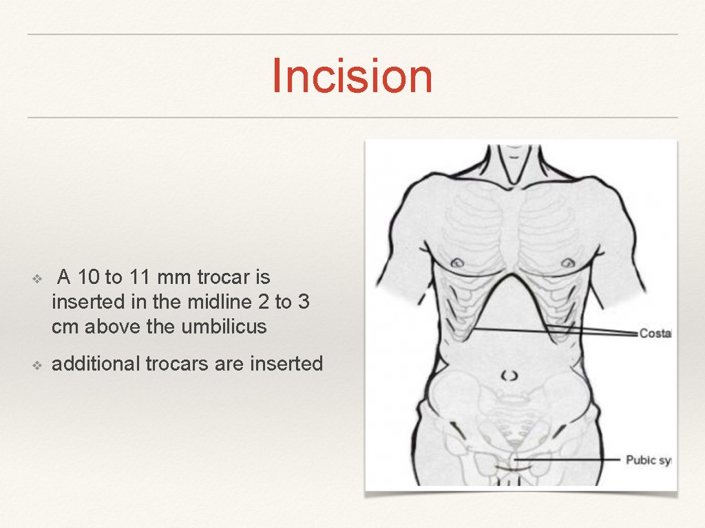 Incision ❖ A 10 to 11 mm trocar is inserted in the midline 2
