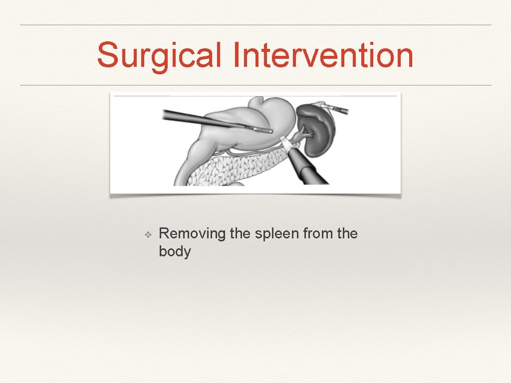 Surgical Intervention ❖ Removing the spleen from the body 