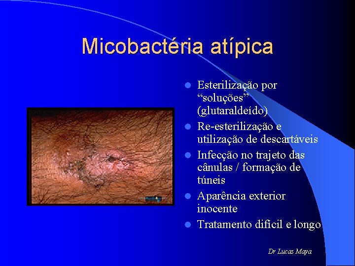 Micobactéria atípica l l l Esterilização por “soluções” (glutaraldeído) Re-esterilização e utilização de descartáveis