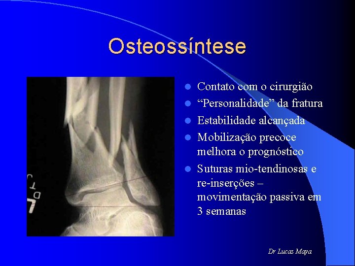 Osteossíntese l l l Contato com o cirurgião “Personalidade” da fratura Estabilidade alcançada Mobilização