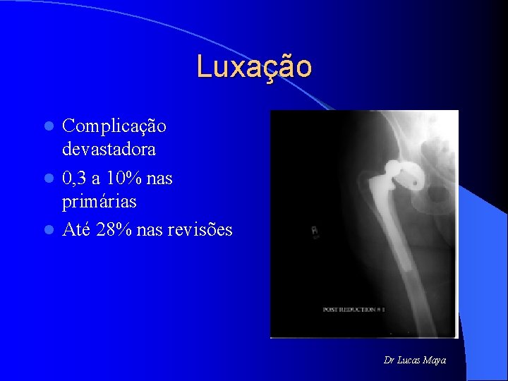 Luxação Complicação devastadora l 0, 3 a 10% nas primárias l Até 28% nas