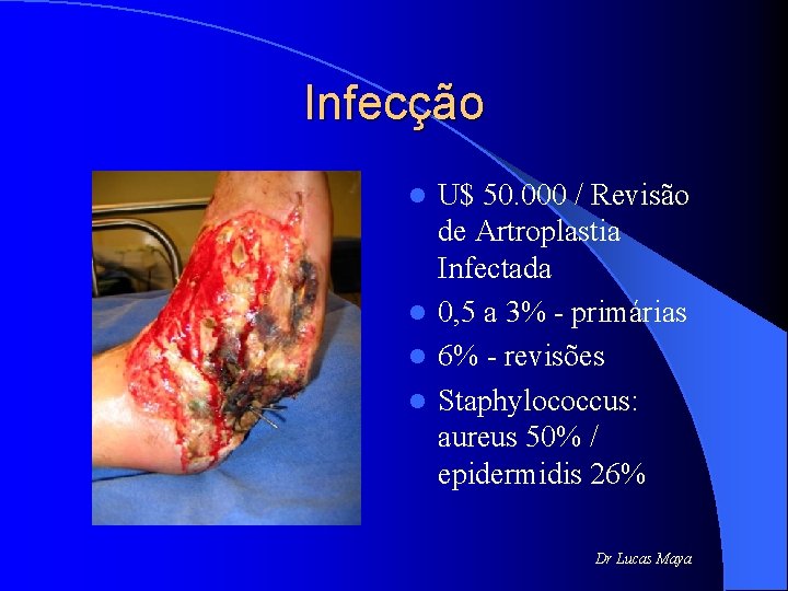 Infecção U$ 50. 000 / Revisão de Artroplastia Infectada l 0, 5 a 3%