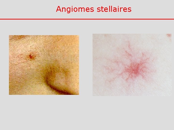 Angiomes stellaires 