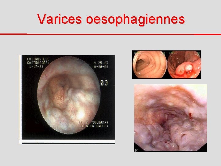 Varices oesophagiennes 