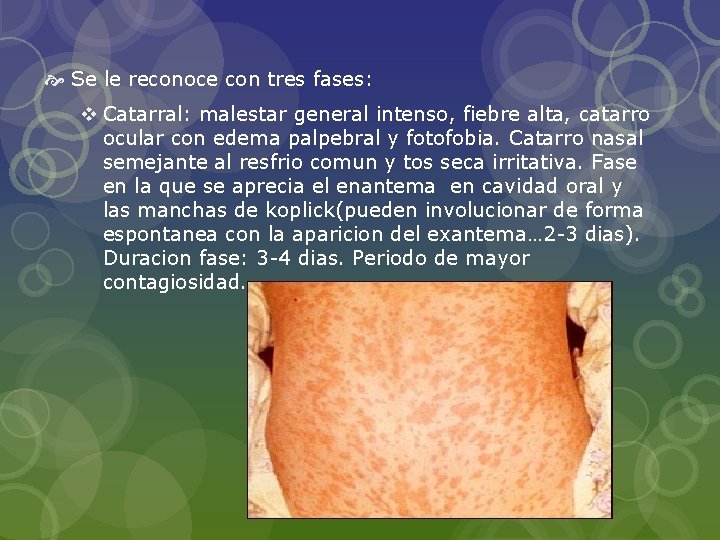  Se le reconoce con tres fases: v Catarral: malestar general intenso, fiebre alta,