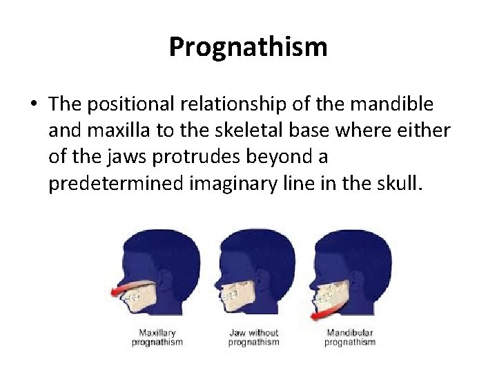 Prognathism • The positional relationship of the mandible and maxilla to the skeletal base