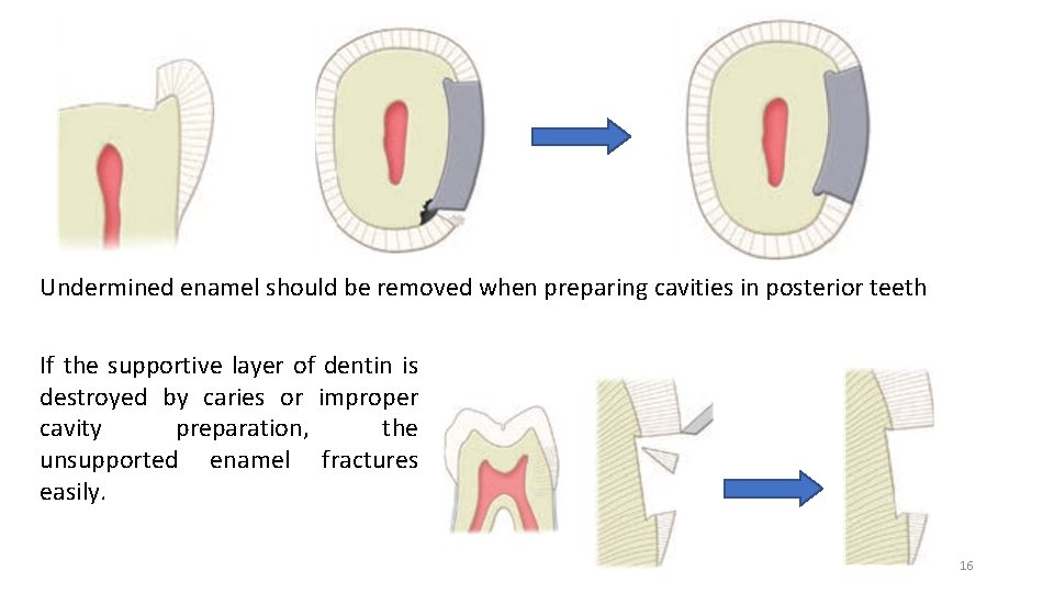 Undermined enamel should be removed when preparing cavities in posterior teeth If the supportive