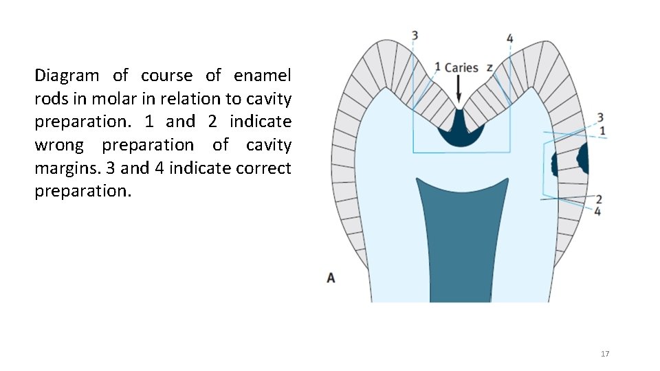 Diagram of course of enamel rods in molar in relation to cavity preparation. 1