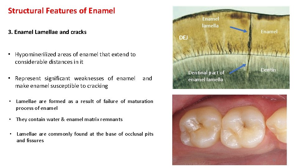 Structural Features of Enamel lamella 3. Enamel Lamellae and cracks DEJ Enamel • Hypominerilized