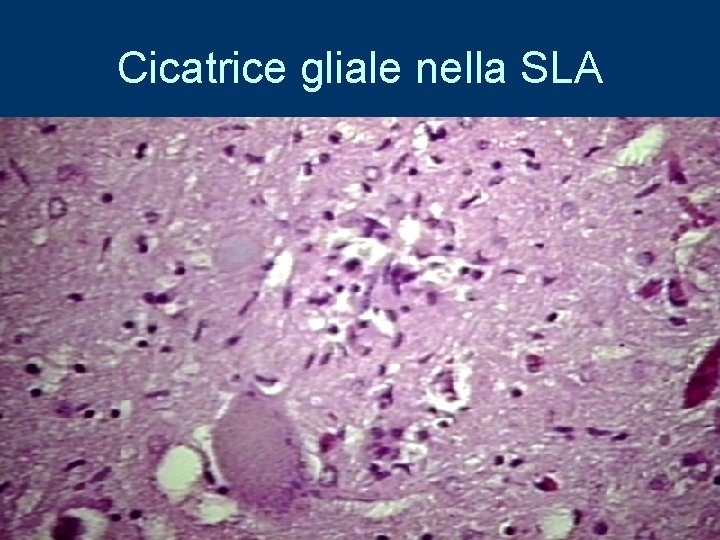 Cicatrice gliale nella SLA 