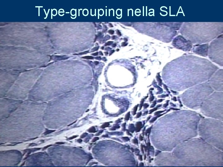 Type-grouping nella SLA 