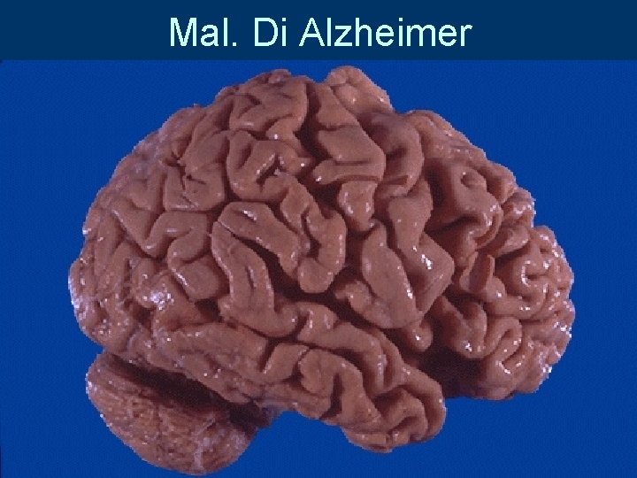 Mal. Di Alzheimer 