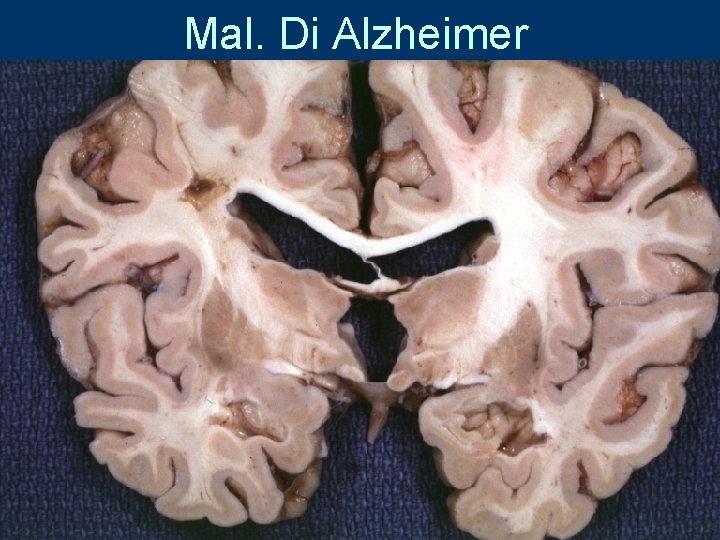 Mal. Di Alzheimer 