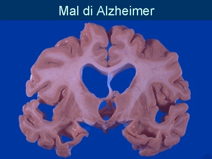 Mal di Alzheimer 