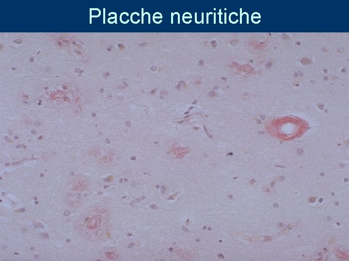 Placche neuritiche 