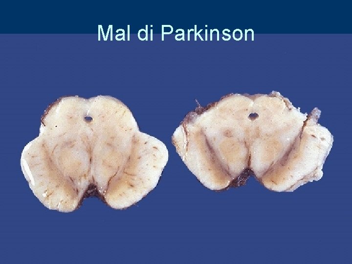 Mal di Parkinson 