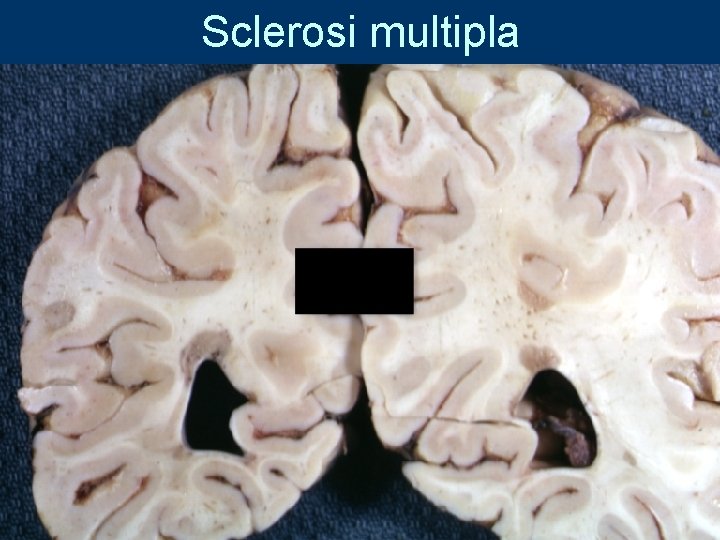 Sclerosi multipla 