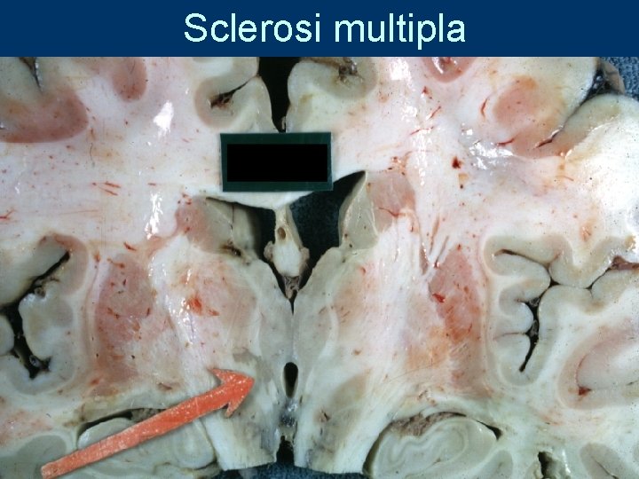 Sclerosi multipla 