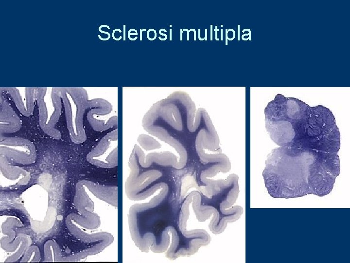 Sclerosi multipla 