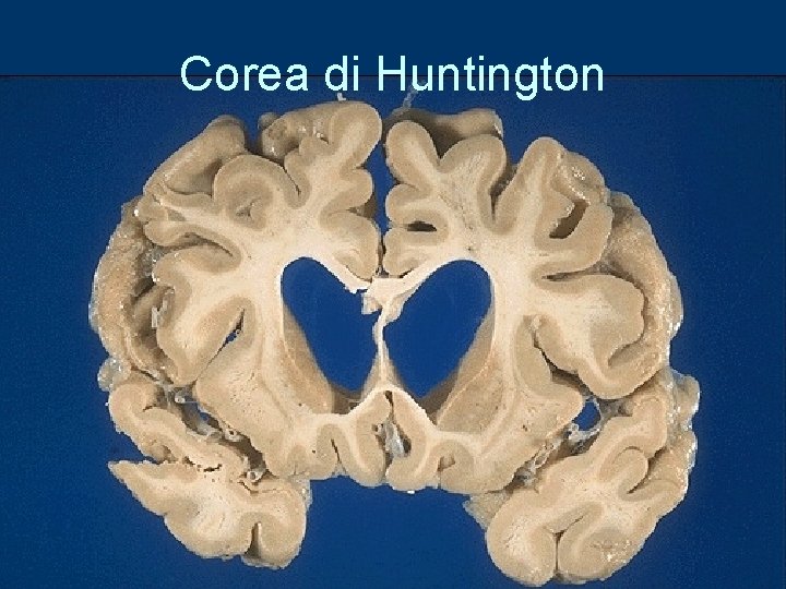 Corea di Huntington 