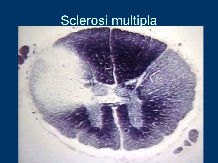 Sclerosi multipla 
