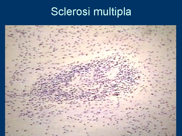 Sclerosi multipla 