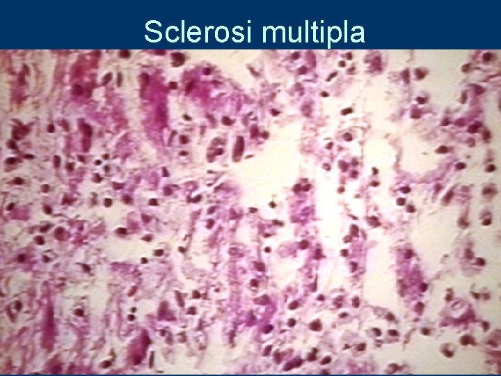 Sclerosi multipla 