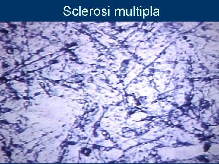 Sclerosi multipla 