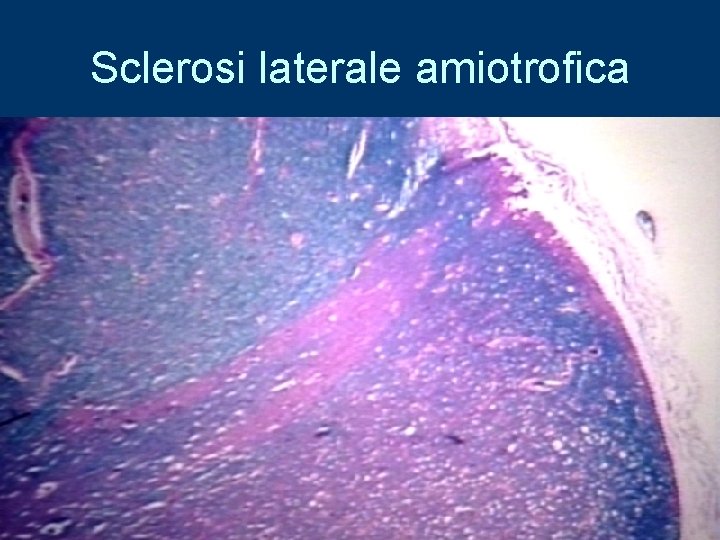 Sclerosi laterale amiotrofica 