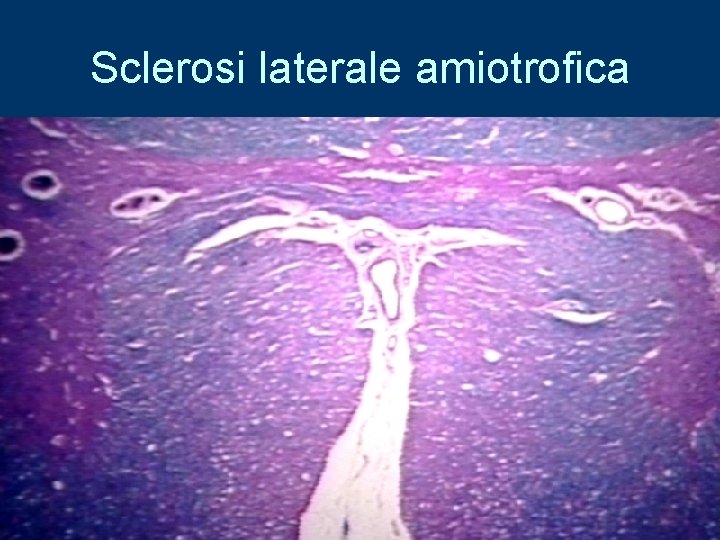 Sclerosi laterale amiotrofica 