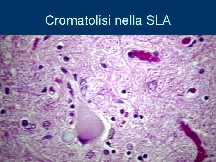 Cromatolisi nella SLA 