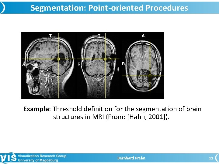 Segmentation: Point-oriented Procedures Example: Threshold definition for the segmentation of brain structures in MRI