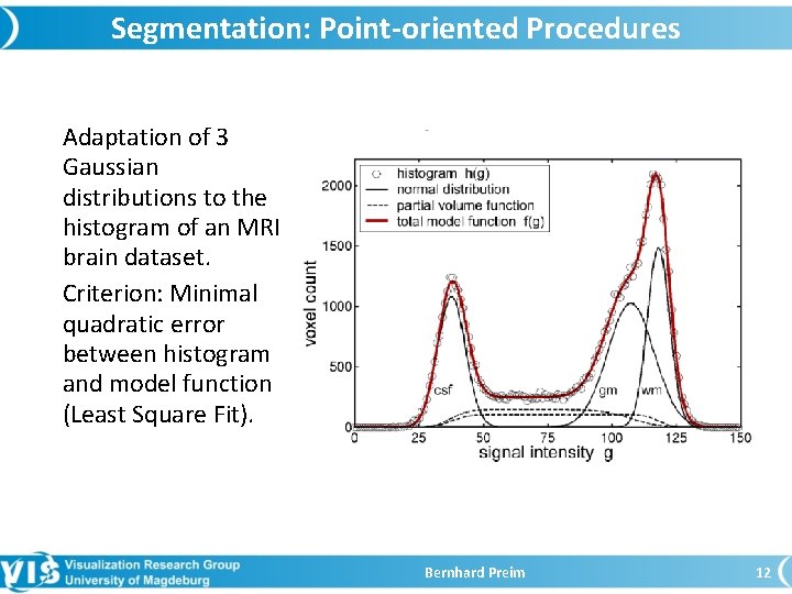 Segmentation: Point-oriented Procedures Adaptation of 3 Gaussian distributions to the histogram of an MRI