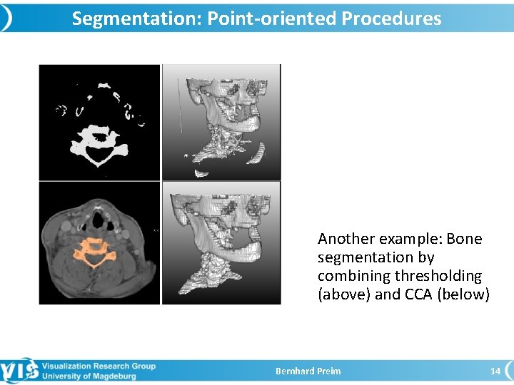 Segmentation: Point-oriented Procedures Another example: Bone segmentation by combining thresholding (above) and CCA (below)