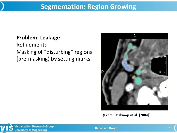 Segmentation: Region Growing Problem: Leakage Refinement: Masking of “disturbing” regions (pre-masking) by setting marks.