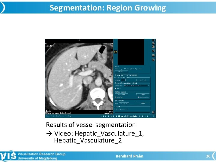 Segmentation: Region Growing Results of vessel segmentation → Video: Hepatic_Vasculature_1, Hepatic_Vasculature_2 Bernhard Preim 20