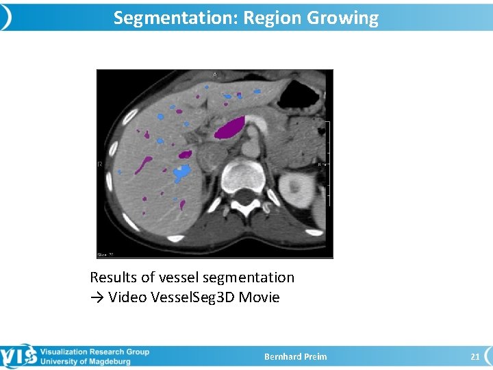 Segmentation: Region Growing Results of vessel segmentation → Video Vessel. Seg 3 D Movie