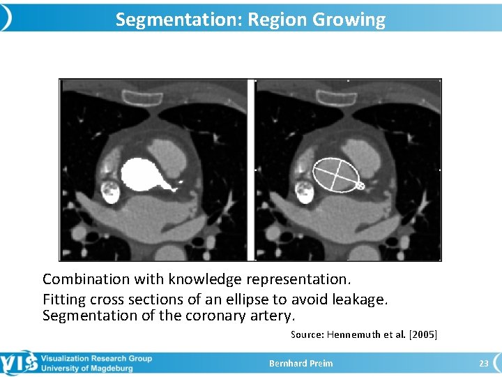 Segmentation: Region Growing Combination with knowledge representation. Fitting cross sections of an ellipse to