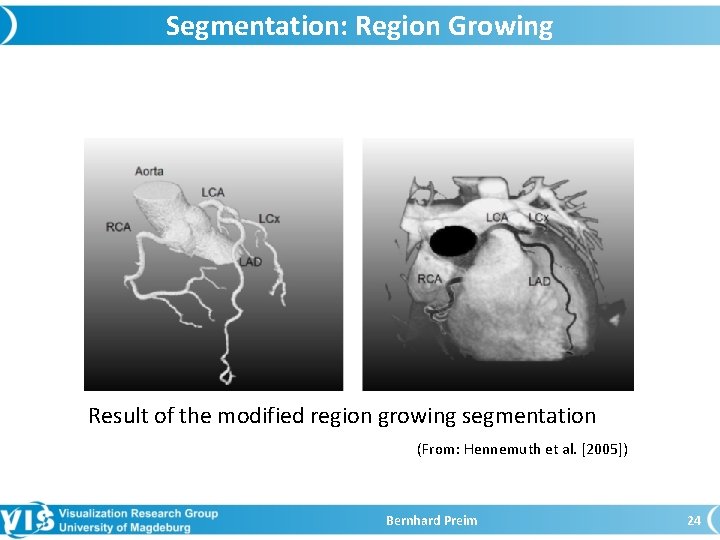 Segmentation: Region Growing Result of the modified region growing segmentation (From: Hennemuth et al.