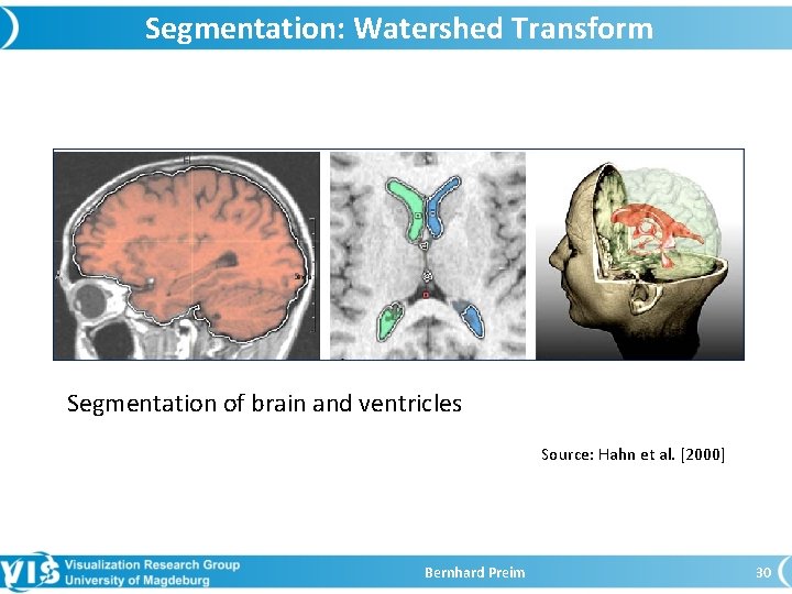 Segmentation: Watershed Transform Segmentation of brain and ventricles Source: Hahn et al. [2000] Bernhard