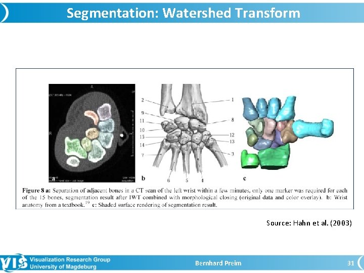 Segmentation: Watershed Transform Source: Hahn et al. (2003) Bernhard Preim 31 