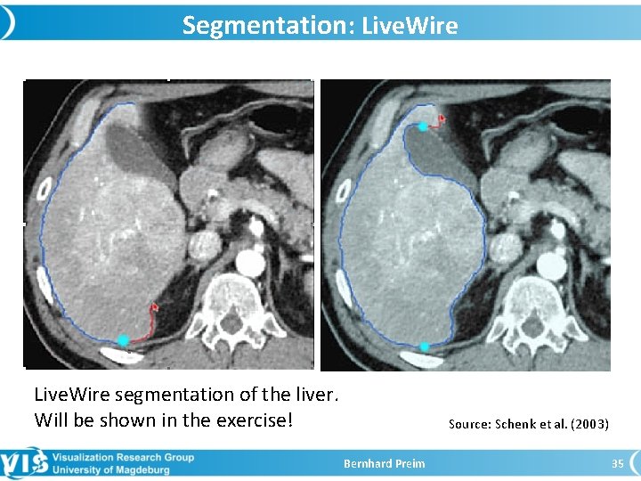 Segmentation: Live. Wire segmentation of the liver. Will be shown in the exercise! Source: