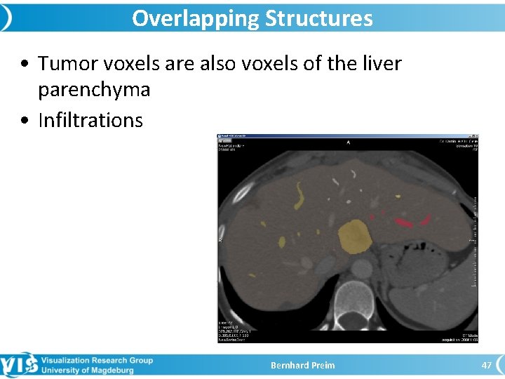 Overlapping Structures • Tumor voxels are also voxels of the liver parenchyma • Infiltrations
